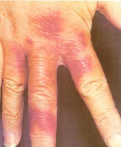 Zoonosi: erisipeloide sulle mani