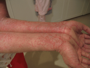 zoonosi Erysipeloid braccia Zoonosi: erisipeloide sulle braccia
