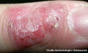 zoonosi 2 Zoonosi: seconda lesione da Mycobacterium