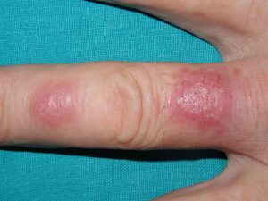 Zoonosi: lesione cutanea da Mycobacterium